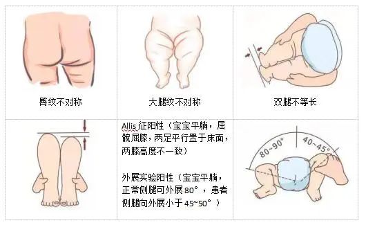 6个月宝宝臀纹不对称,关于六个月宝宝臀纹不对称的探讨